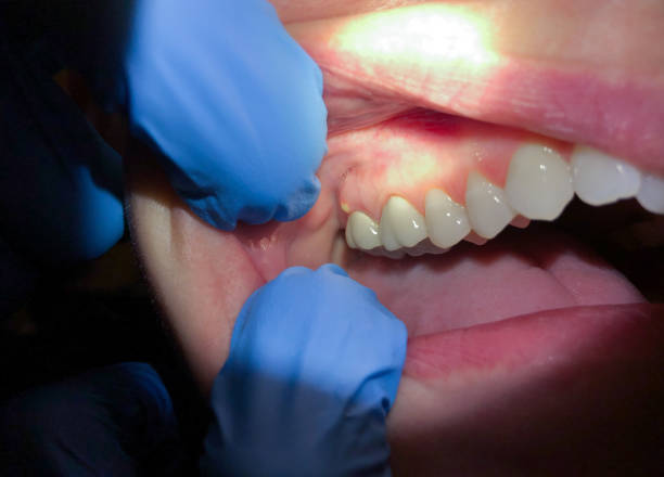 Best Emergency Gum Treatment in Frankenmuth, MI