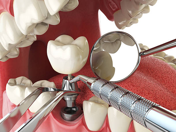 Best Urgent Care for Lost Fillings or Crowns in Frankenmuth, MI